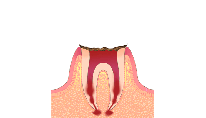 C4：歯質が失われた虫歯