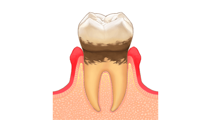 歯周病